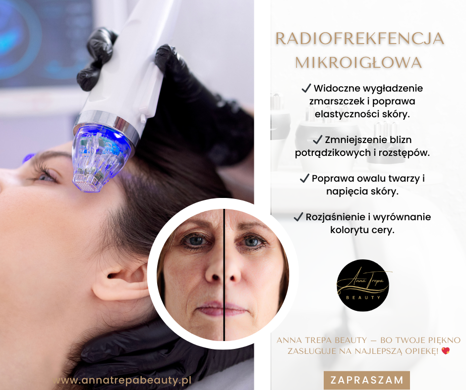 Radiofrekfencja mikroigłowa - Gdańsk Anna Trepa Beauty